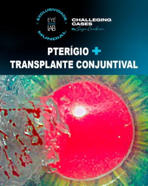 EYELAB Pterígio + Transplante Conjuntival