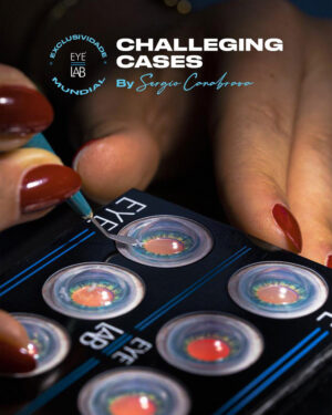 Cartela Challenging Cases Small Pupil + Faco