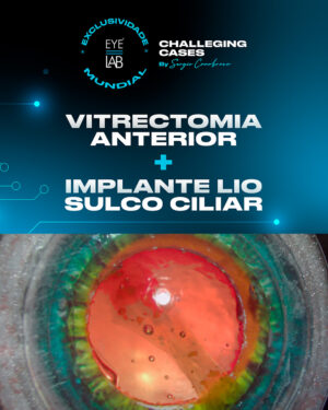 EYELAB Challenging Cases Módulo Vitrectomia Anterior + Implante LIO Sulco Ciliar