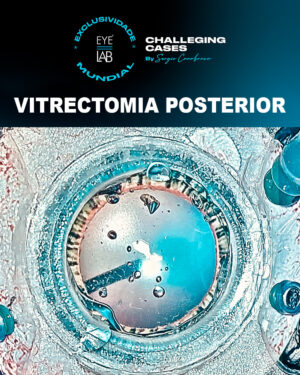 EM BREVE! EYELAB Vitrectomia Posterior